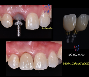 TRỒNG IMPLANT VÙNG RĂNG CỬA NHƯ RĂNG THẬT